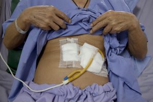 tube feeding man patient stomach lying on hospital bed